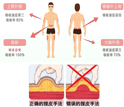 胰岛素注射部位：科学选择，助力控糖