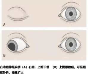 睁眼困难、视物成双  可能是动眼神经罢工啦